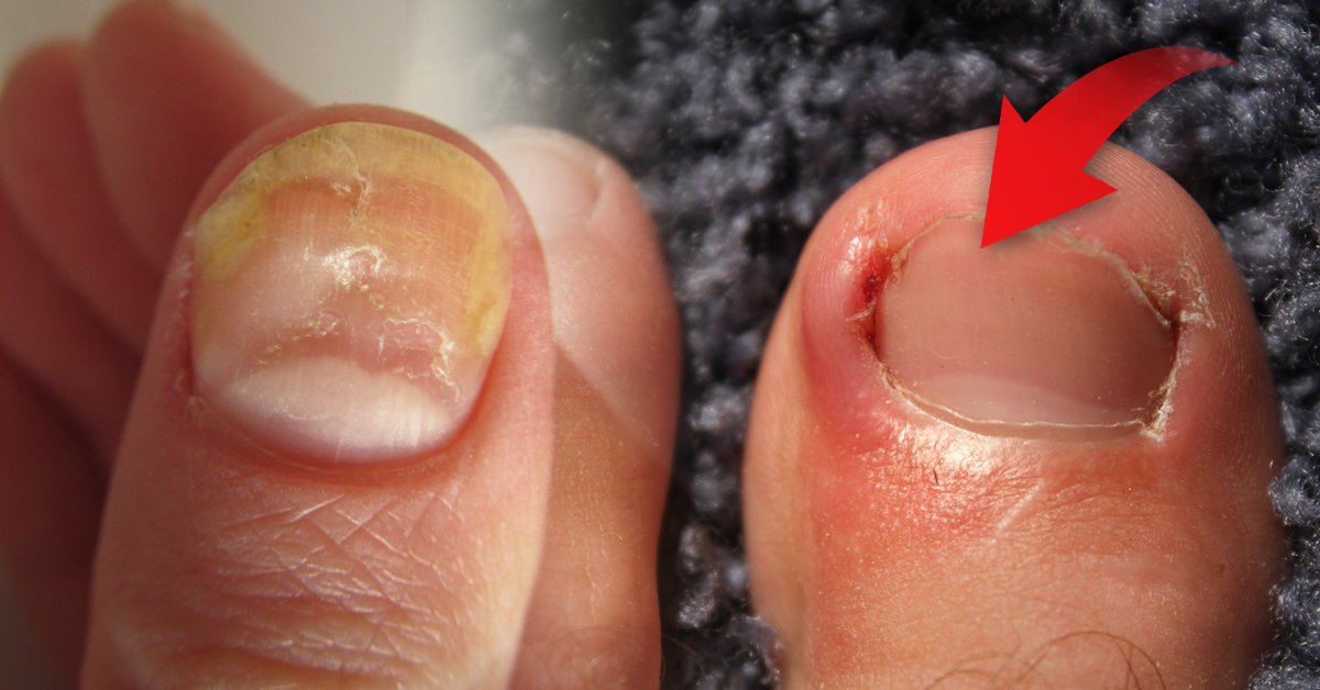 Como curar los hongos en medio de los dedos de los pies